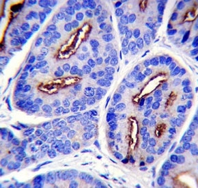 Immunohistochemistry analysis of PSMA/FOLH1 antibody in human prostate carcinoma tissue. Formalin-fixed, paraffin-embedded human prostate carcinoma tissue was stained using PSMA antibody. Heat-induced epitope retrieval was performed by steaming tissue sections in citrate buffer, pH 6.0, for 20 minutes, followed by cooling prior to antibody incubation. Brown chromogenic signal is observed predominantly along the apical and membranous surfaces of malignant glandular epithelial cells, with luminal accentuation in tumor glands, while surrounding stromal regions show minimal staining. This staining pattern reflects epithelial-associated expression of PSMA in prostate carcinoma tissue.