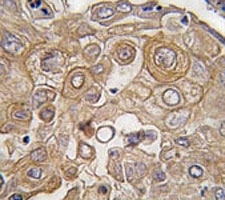 IHC analysis of FFPE human lung carcinoma tissue stained with TLR6 antibody