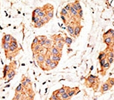 IHC analysis of FFPE human breast carcinoma tissue stained with the Connexin 43 antibody