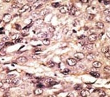 IHC analysis of FFPE human hepatocarcinoma tissue stained with the ATG7 antibody