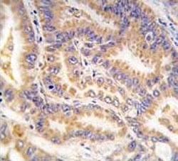 IHC analysis of FFPE human lung carcinoma tissue stained with ATG12 antibody
