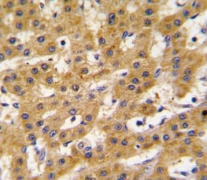 IHC analysis of FFPE human hepatocarcinoma tissue stained with PDX1 antibody