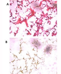 (A) H&E staining of frozen human ovarian cancer tissue with UCH37 antibody at 1:250. (B) 60X magnification.