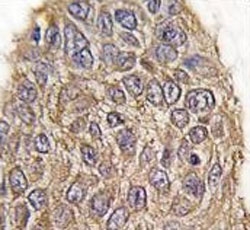IHC analysis of FFPE human lung carcinoma tissue stained with Aldolase antibody