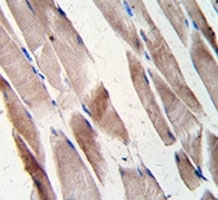 Desmin antibody staining of human hepatocarcinoma tissue