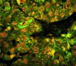 CD38 Antibody for IF human hepatocarcinoma tissue. Immunofluorescence analysis of CD38 / plasma cell marker expression in paraffin-embedded human hepatocarcinoma tissue using a CD38 antibody. Green fluorescence (FITC) highlights CD38 expression with predominantly membranous and cytoplasmic signal, while nuclei are counterstained with propidium iodide (red). The staining demonstrates localization of CD38-positive cells within the tumor microenvironment with clear contrast between fluorescent signal and nuclear regions.