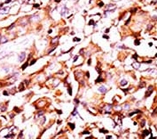 IHC analysis of FFPE human breast carcinoma tissue stained with the phospho-Bad antibody.