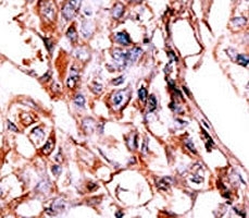 Phospho-HER4 (pY1188) Antibody Hepatocarcinoma Tissue IHC. Immunohistochemistry analysis of FFPE human hepatocarcinoma stained with Phospho-HER4 (pY1188) Antibody demonstrates moderate HRP-DAB brown cytoplasmic and membranous staining in tumor cells, consistent with regulated ERBB4 / HER4 phosphorylation, while surrounding tissue exhibits lower background; nuclei are counterstained blue.