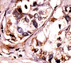 IHC analysis of FFPE human hepatocarcinoma tissue stained with the phospho-Syk antibody.