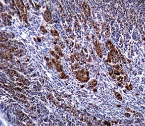 S100B antibody immunohistochemistry analysis in formalin fixed and paraffin embedded human malignant melanoma.
