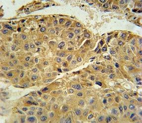 Beta III Tubulin antibody immunohistochemistry analysis in formalin fixed and paraffin embedded human hepatocarcinoma.