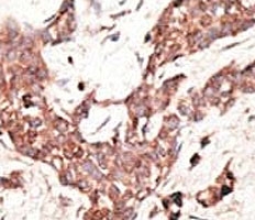 SIRT3 Antibody Breast Cancer IHC. Immunohistochemistry analysis of FFPE human breast carcinoma tissue stained with the SIRT3 antibody.