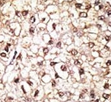 PRKN Antibody Human Hepatocellular Carcinoma IHC. IHC staining of FFPE human hepatocellular carcinoma tissue was performed with PRKN Antibody. Positive PRKN/Parkin staining is observed predominantly in the cytoplasm of tumor cells. This PRKN Antibody demonstrates cellular localization of Parkin RBR E3 ubiquitin ligase in human hepatocellular carcinoma tissue.