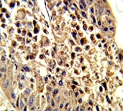 IHC analysis of FFPE human hepatocarcinoma stained with VDAC1 antibody