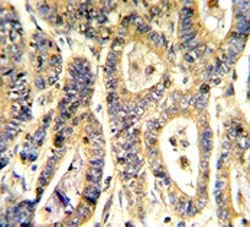 IHC analysis of FFPE human colon carcinoma stained with IGFBP6 antibody