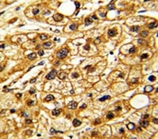 IHC analysis of FFPE human hepatocarcinoma stained with CD11c antibody