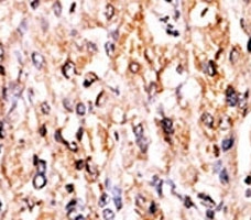 IHC analysis of FFPE human hepatocarcinoma tissue stained with the GCN2 antibody