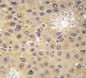 IHC analysis of FFPE human hepatocarcinoma tissue stained with ACAT1 antibody