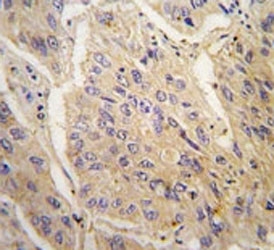 IHC analysis of FFPE human lung carcinoma tissue stained with anti-Caspase-3 antibody
