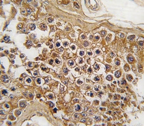 ALK Antibody Testicular Tissue IHC. Immunohistochemistry analysis of FFPE human testis tissue using ALK antibody demonstrates diffuse cytoplasmic and membranous HRP-DAB brown staining within seminiferous epithelial-associated cellular populations. The staining pattern highlights distinct cellular outlining and intracellular signal distribution consistent with ALK-associated protein expression in testicular tissue compartments.