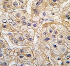 EGF Receptor Antibody Hepatocarcinoma IHC. Immunohistochemistry analysis of FFPE human hepatocarcinoma tissue stained with the EGF Receptor antibody.