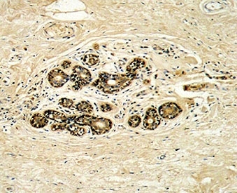HER3 Antibody Breast Carcinoma Tissue IHC. Immunohistochemistry analysis of FFPE human breast carcinoma stained with HER3 Antibody / ERBB3 Tumor Signaling Antibody demonstrates moderate to strong HRP-DAB brown membranous and cytoplasmic staining in tumor epithelial cells, consistent with ERBB3 expression, while surrounding stromal cells show minimal background; nuclei are counterstained blue.