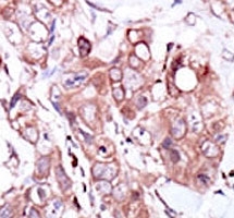 ERBB4 Antibody IHC. Immunohistochemistry analysis of FFPE human breast carcinoma tissue stained with the ERBB4 antibody.