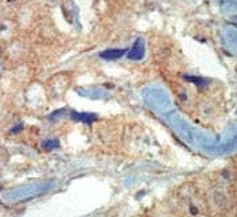 FLT3 Antibody Breast Cancer IHC. Immunohistochemistry analysis of FFPE human breast carcinoma tissue stained with the FLT3 antibody.