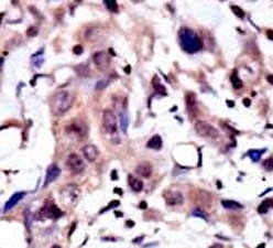 IHC analysis of FFPE human breast carcinoma tissue stained with the MUSK antibody