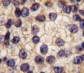 PDGFR Alpha Antibody Prostate Carcinoma IHC. Immunohistochemistry staining of FFPE human prostate carcinoma tissue using PDGFR Alpha Antibody / Receptor Tyrosine Kinase Antibody demonstrates membranous and cytoplasmic HRP-DAB brown staining within malignant epithelial cells. The staining pattern is consistent with expression of PDGFRA, a receptor tyrosine kinase that mediates platelet-derived growth factor signaling and regulates cellular proliferation, migration, differentiation, and survival. PDGFRA signaling contributes to communication between tumor cells and the surrounding microenvironment and has been extensively studied in cancer biology due to its roles in growth factor-mediated signaling and tissue remodeling. The observed staining supports expression of PDGFRA in prostate carcinoma-associated cellular populations.