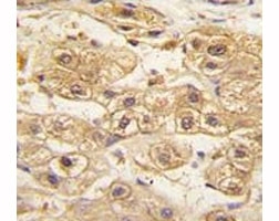 IHC analysis of FFPE human hepatocarcinoma tissue stained with PDGFRB antibody