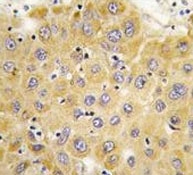 Connective Tissue Growth Factor Antibody Hepatocellular Carcinoma IHC. Immunohistochemistry staining of FFPE human hepatocellular carcinoma tissue using Connective Tissue Growth Factor Antibody demonstrates moderate cytoplasmic HRP-DAB brown staining within malignant hepatocellular populations. The staining pattern is consistent with expression of Connective Tissue Growth Factor (CTGF), also known as Cellular Communication Network Factor 2 (CCN2), a matricellular protein involved in extracellular matrix regulation, tissue remodeling, cellular signaling, and tumor-stroma interactions. The observed immunoreactivity highlights CTGF expression within neoplastic cells and supports its established role in pathways associated with tumor progression, angiogenesis, wound healing, and extracellular matrix remodeling. This staining pattern demonstrates the utility of CTGF antibodies for studies of liver cancer biology, connective tissue signaling, and tumor microenvironment regulation.