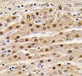 IHC analysis of FFPE human hepatocarcinoma tissue stained with anti-GAPDH antibody