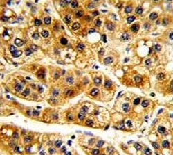 IkB alpha Antibody Hepatocarcinoma IHC. Immunohistochemistry analysis of FFPE human hepatocarcinoma with IkB alpha antibody.
