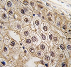 IHC analysis of FFPE human hepatocarcinoma tissue stained with PERK antibody