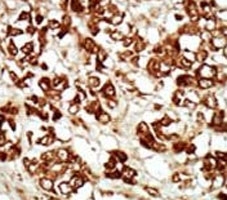 IHC analysis of FFPE human hepatocarcinoma tissue stained with the ZAK antibody