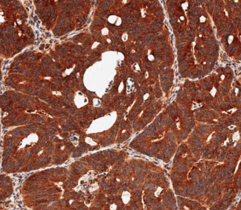 DUSP6 Antibody Human Colon Carcinoma IHC. Immunohistochemical staining of FFPE human colon carcinoma tissue using DUSP6 antibody demonstrates strong and widespread cytoplasmic HRP-DAB brown staining throughout neoplastic gland-forming epithelial cells. The staining pattern is consistent with expression of DUSP6 (Dual Specificity Phosphatase 6), a key negative regulator of ERK/MAPK signaling pathways. DUSP6 modulates intracellular signal transduction by dephosphorylating activated ERK proteins, thereby helping regulate cellular responses to growth factor stimulation, differentiation signals, and proliferative cues. The robust staining observed within malignant epithelial structures supports the role of DUSP6 in maintaining signaling homeostasis within pathways that influence cellular growth and tissue organization. HIER: steam sections in pH 9 EDTA for 20 minutes and allow to cool prior to staining.