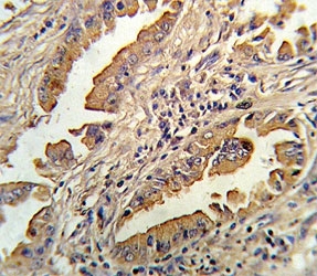 IHC analysis of FFPE human lung carcinoma stained with IL-8 antibody