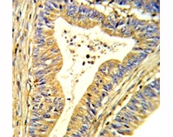 IHC analysis of FFPE human colon carcinoma stained with SOD1 antibody