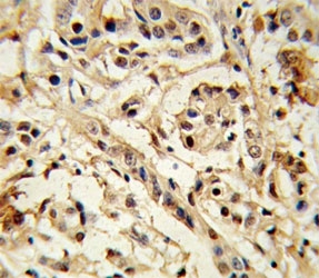 BMI1 Antibody Breast Carcinoma IHC. Immunohistochemistry analysis of FFPE human breast carcinoma stained with BMI1 antibody.