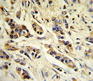 IHC analysis of FFPE human breast carcinoma stained with IL-10 antibody