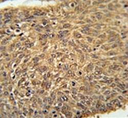 ATG13 antibody immunohistochemistry analysis in formalin fixed and paraffin embedded human lung carcinoma.
