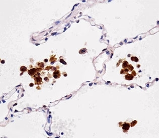 FABP4 Antibody Lung IHC. Immunohistochemical analysis of paraffin-embedded human lung using FABP4 antibody at 1:25 dilution.