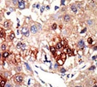 EZH2 Antibody Hepatocarcinoma IHC. Immunohistochemistry analysis of FFPE human hepatocarcinoma tissue stained with the EZH2 antibody.