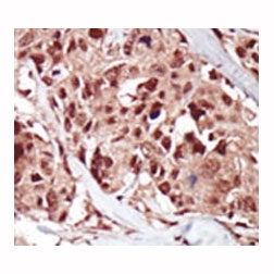 Immunohistochemistry of BRD4 antibody in human breast carcinoma tissue. FFPE human breast carcinoma shows predominantly nuclear HRP-DAB brown staining within tumor epithelial cells, consistent with the known nuclear localization of Bromodomain-containing protein 4 as a chromatin-associated transcriptional regulator. The antibody targets the N-terminal region of BRD4.