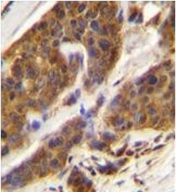 IHC testing of FFPE human bladder carcinoma with Complement Factor D antibody. HIER: steam section in pH6 citrate buffer for 20 min and allow to cool prior to staining.