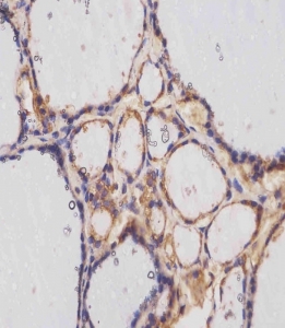 IHC testing of FFPE human thyroid tissue with TERT antibody. HIER: steam section in pH6 citrate buffer for 20 min and allow to cool prior to staining.