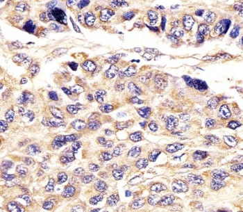 IHC testing of FFPE human hepatocarcinoma with AGXT antibody. HIER: steam section in pH6 citrate buffer for 20 min and allow to cool prior to staining.