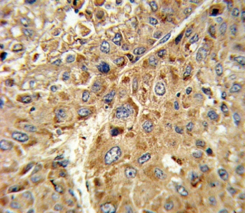 IHC testing of FFPE human hepatocarcinoma tissue with GPX1 antibody. HIER: steam section in pH6 citrate buffer for 20 min and allow to cool prior to staining.