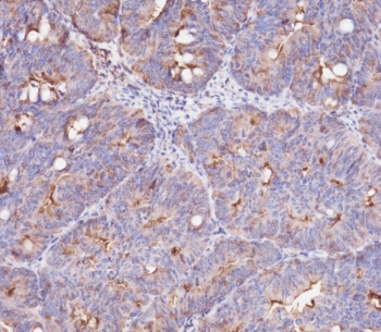 IHC testing of FFPE human colon carcinoma tissue with IFITM3 antibody. HIER: steam section in pH6 citrate buffer for 20 min and allow to cool prior to staining.